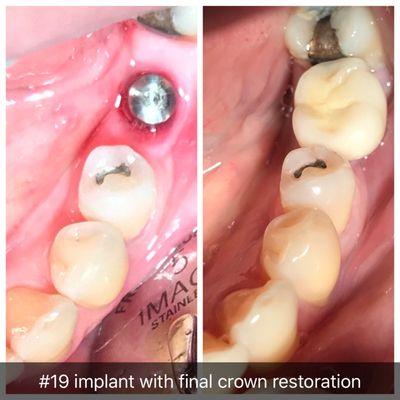 Missing molar.  Implant and Crown.