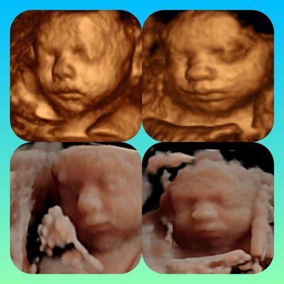 Ultrasound 3D4D5DHD