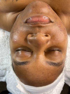 Acne Facial