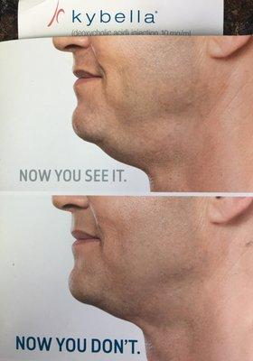 Kybella for submental fat removal.