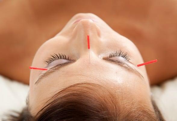 Smooth aging lines, and firm up underlying muscles  with facial acupuncture.