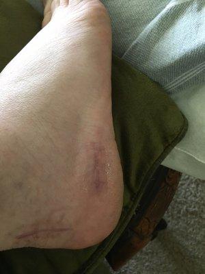 8 weeks after duel heal spur surgery.