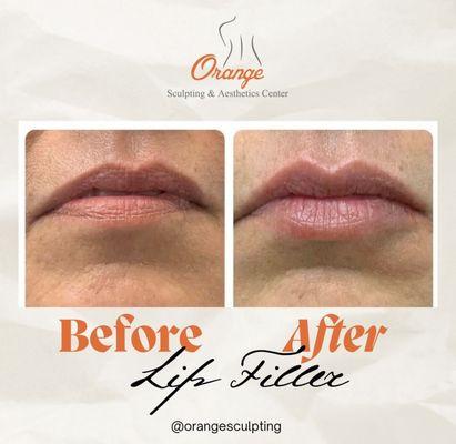 Natural
Looking results - Lip filler