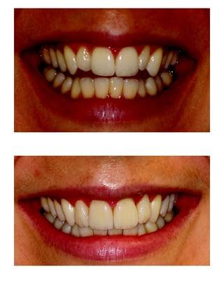 before and after of our smile design.