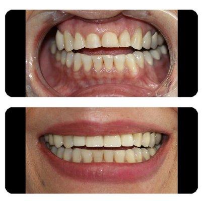 Severe worn teeth. Repaired with Zirconia crowns.