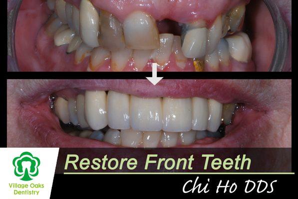 Upper front teeth are restored with a Bridge that eliminated teeth decay and corrected misalignment at the same time.