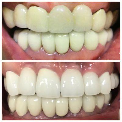 Before and After implants. 5, 6, 7, 9, 10, and 12 implants. 8 and 11 natural teeth. 4 Year Post Op Picture.