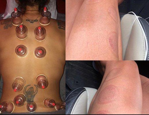 Cupping to help remove toxins from muscle or break down adhesion and myofascial tissue.