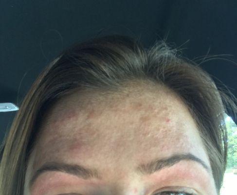 Right after threading my entire forehead was apparently threaded and irritated!! Why???