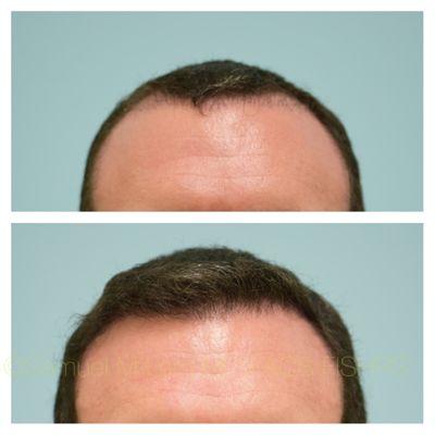 This 37-year-old gentleman is shown before and 6 months after FUE hair transplant