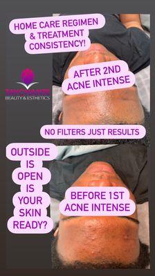 Acne Treatment Facial