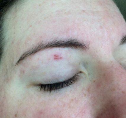 The small abrasions left on my eyelid after my threading on Thursday May 18.