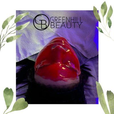 Vampire PLLA facials available at Greenhill Beauty