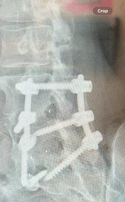 Lumbar spine