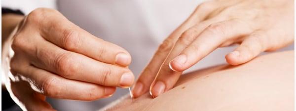 Best Acupunture Dr. in Los Gatos