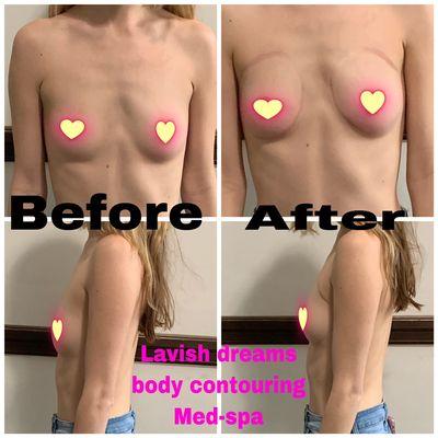 Before and after One breast enhancement treatment