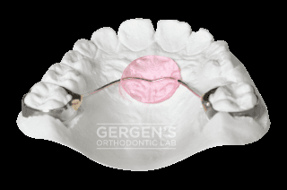 Nance fabricated in the USA by David Gergen from Gergen's Orthodontic Lab