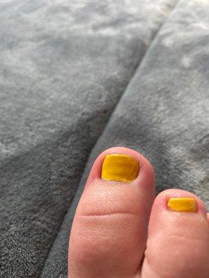 Bad pedicure