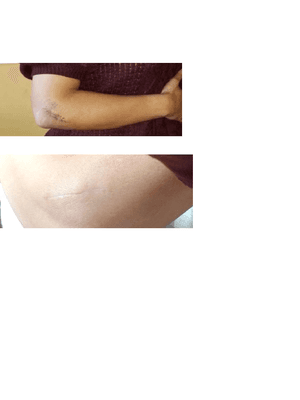 Elbow before and after treatment