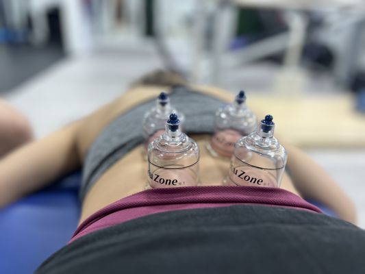 cupping