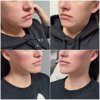 Facial balancing and harmonization with dermal filler.