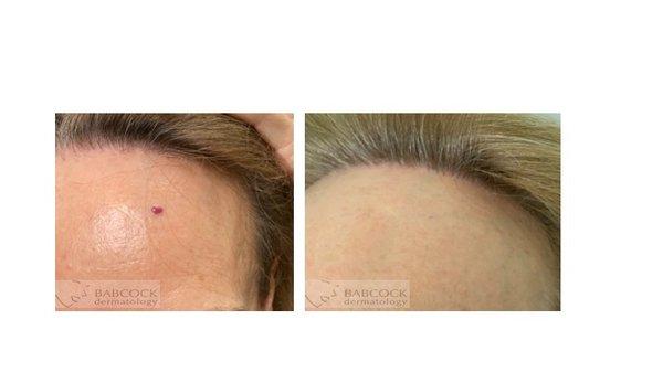 Icon Laser to reduce red spots