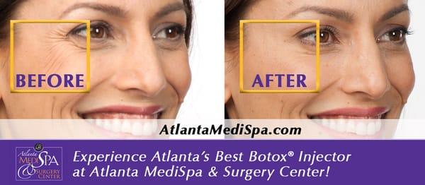 Dr. Atkins has been continually named Best Botox Injector by CBS News.