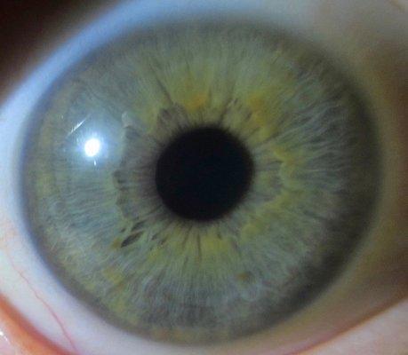 Iridology Photo. Determining genetic strengths and weaknesses through your iris, your body's wealth of information.