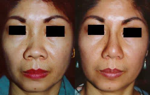 asian rhinoplasty