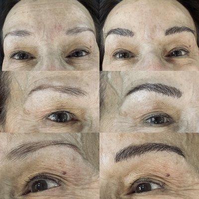 Combo Brow procedure