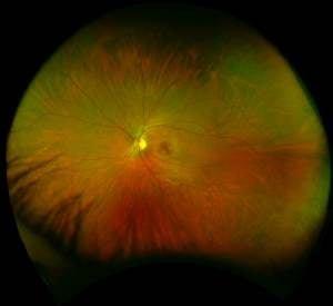 Our retinal imaging technology lets you see more of the retina, which enables us to more effectively detect and monitor patient health.