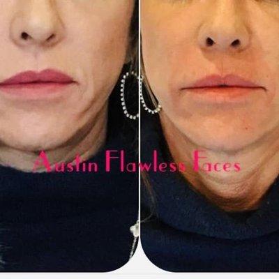 Lower face rejuvenation with filler. No more jowls:)