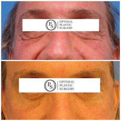 Lower Blepharoplasty