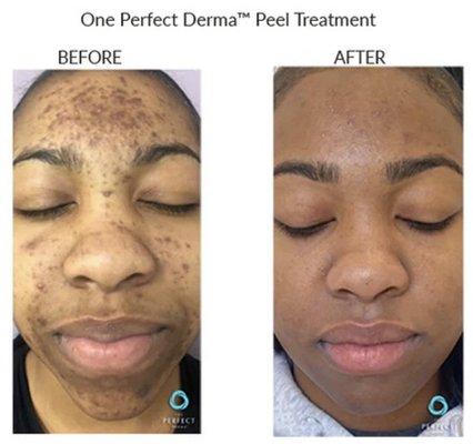 The Perfect Derma Peel Results