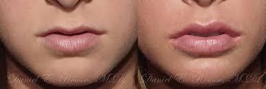 Botox, LIp flips, Fillers. Laser, PRF ,  induced lips for fuller lips