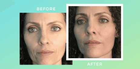 Microneedling Before & After