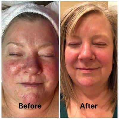 Wondering what I can to help with Rosacea? A lot.  Call, text or message me or book your appointment at www.cindyravn.com.