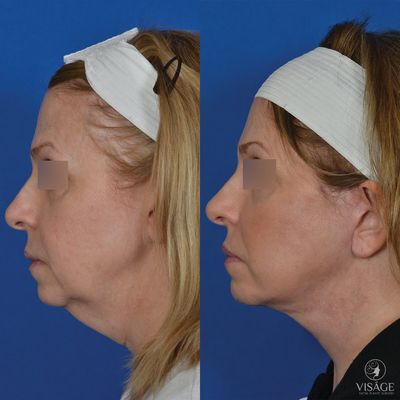 Before/after chin liposuction