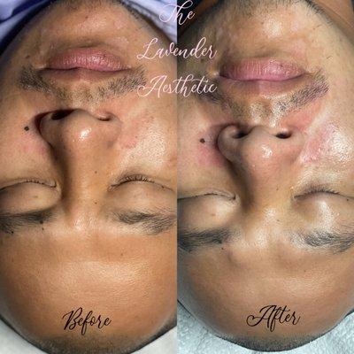 Before and After mild chemical peel for scarring and balancing skin tone.