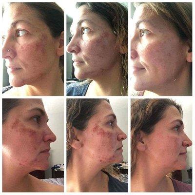 1st, 2nd, and 12th day of a powere peel  *results may vary *this was her second power peel * should be done in a series 2-6 for max results