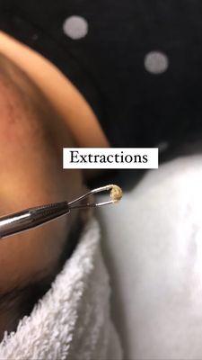 Extractions  Come remove the gunkie