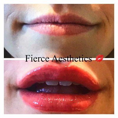 Lip enhancement with Juvederm XC