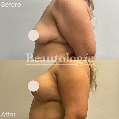 Bilateral Breast Lift with 450ml Silicone Implants Before and After