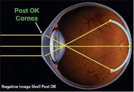 Ortho-K lenses helps the lights are focusing right on the retina. With that cornea shaping, you don't need the glasses or CL.