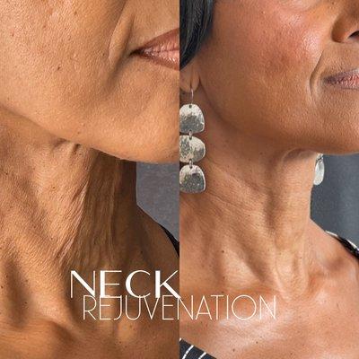 Neck Rejuvenation