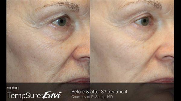 TempSure before/after wrinkle reduction/skin tightening