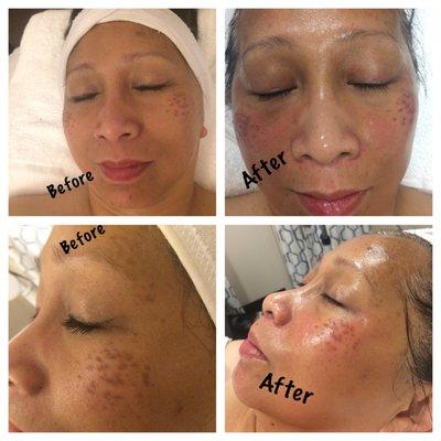 first session need to lift clients discoloration from sun spots - hyperpigmentation.  it will take 5 to 6 treatments to lift sun spots