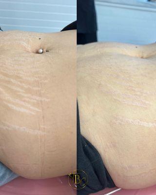 Inkless Stretch Mark Rejuvenation - After 1 Session