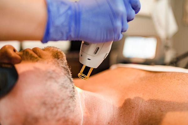 Laser Hair Removal