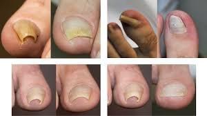 Toenail correction/brace for ingrown or trumpet nails. Straightens toenails that grow into skin, relives pain.